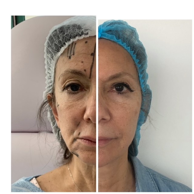 Tratamiento de rejuvenecimiento