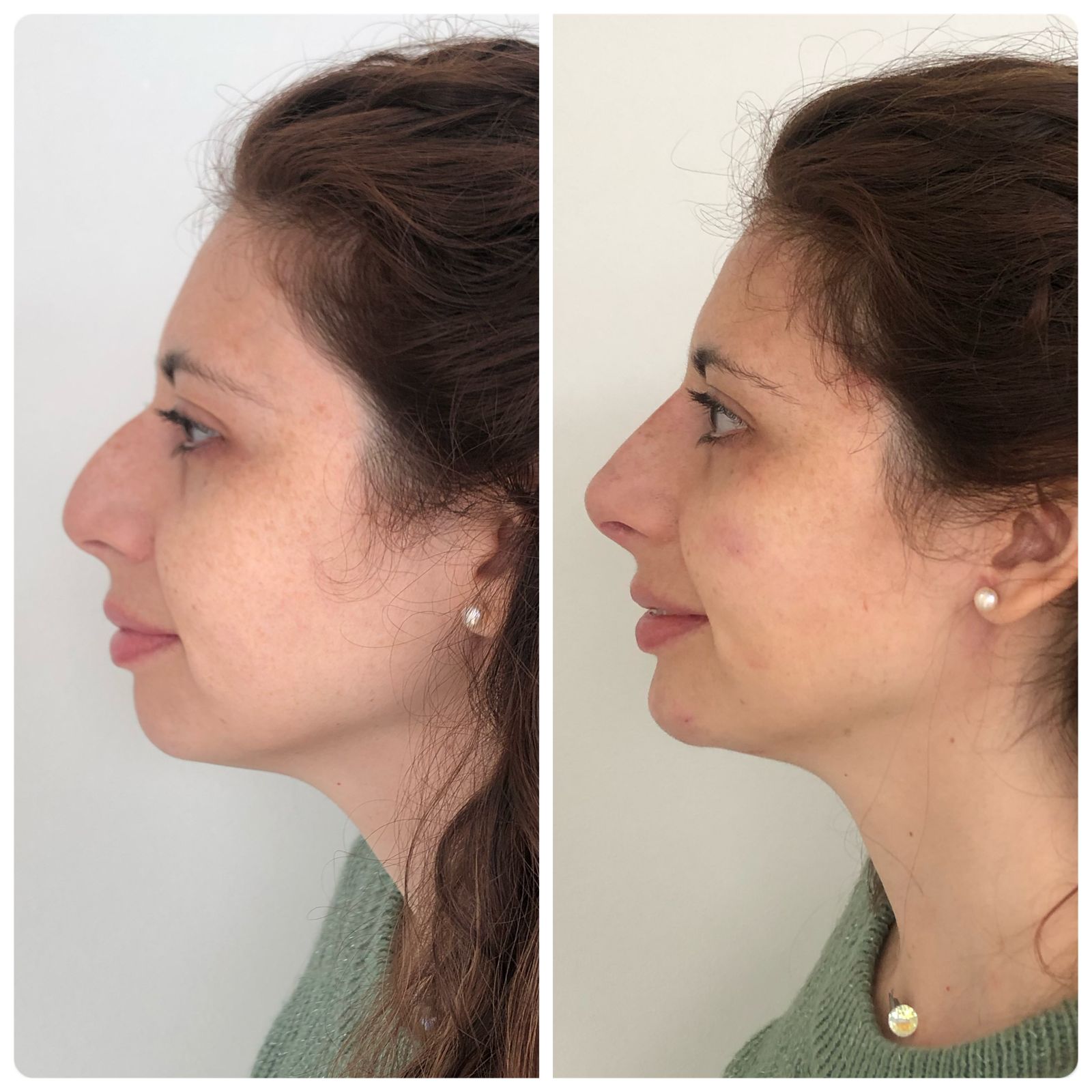 Nariz, ojeras y mentón