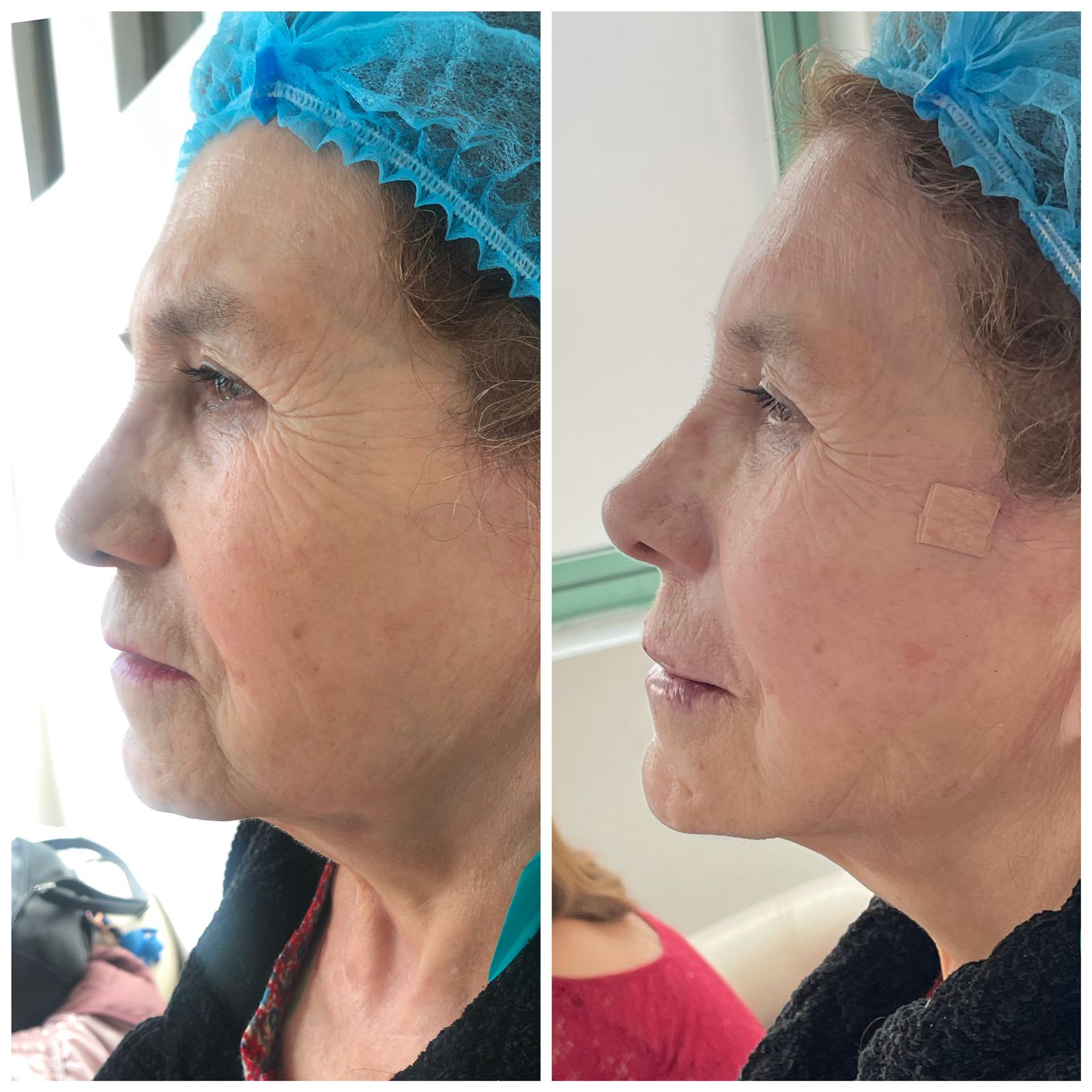 Armonización Completa