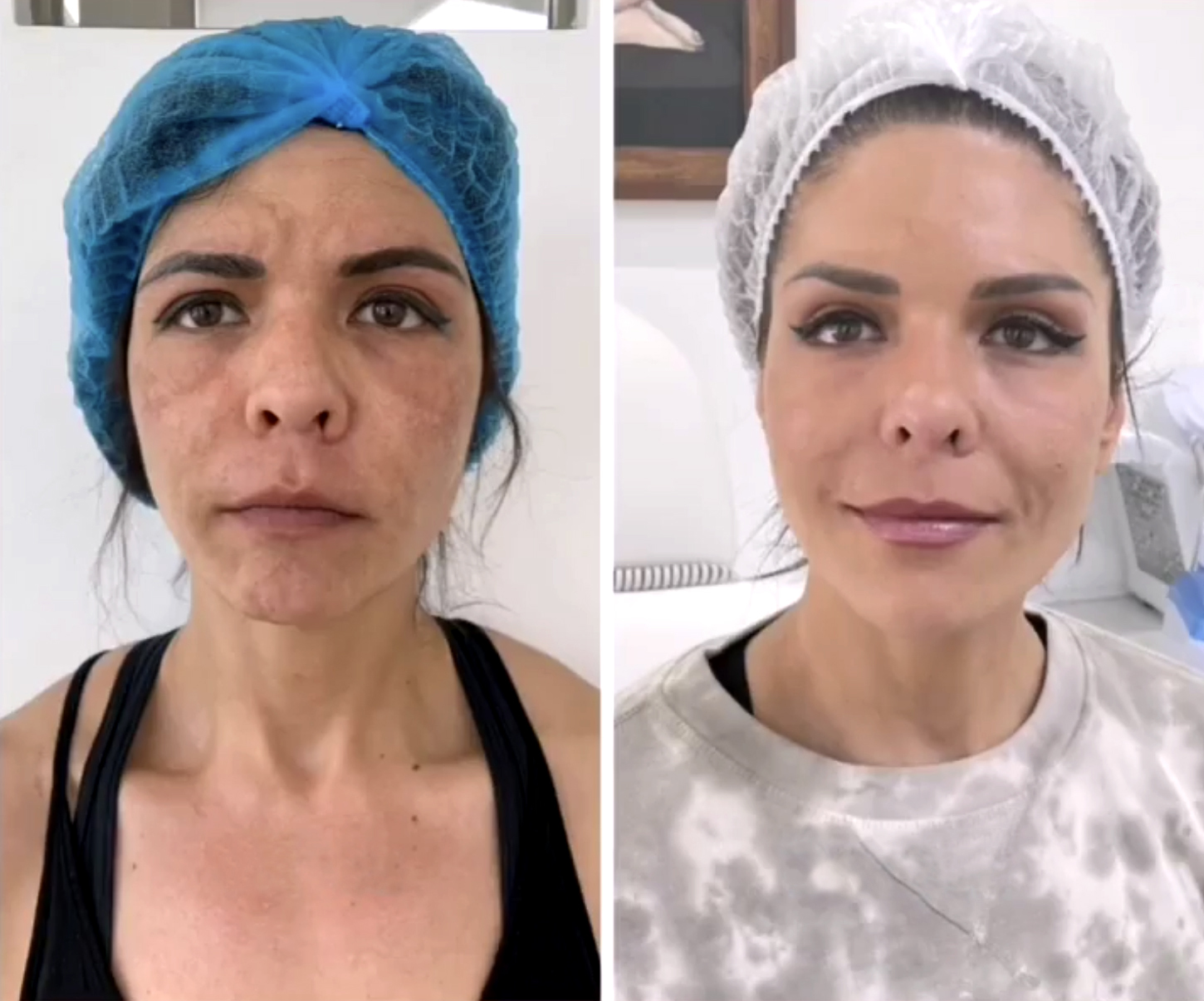 Técnica puntos lifting