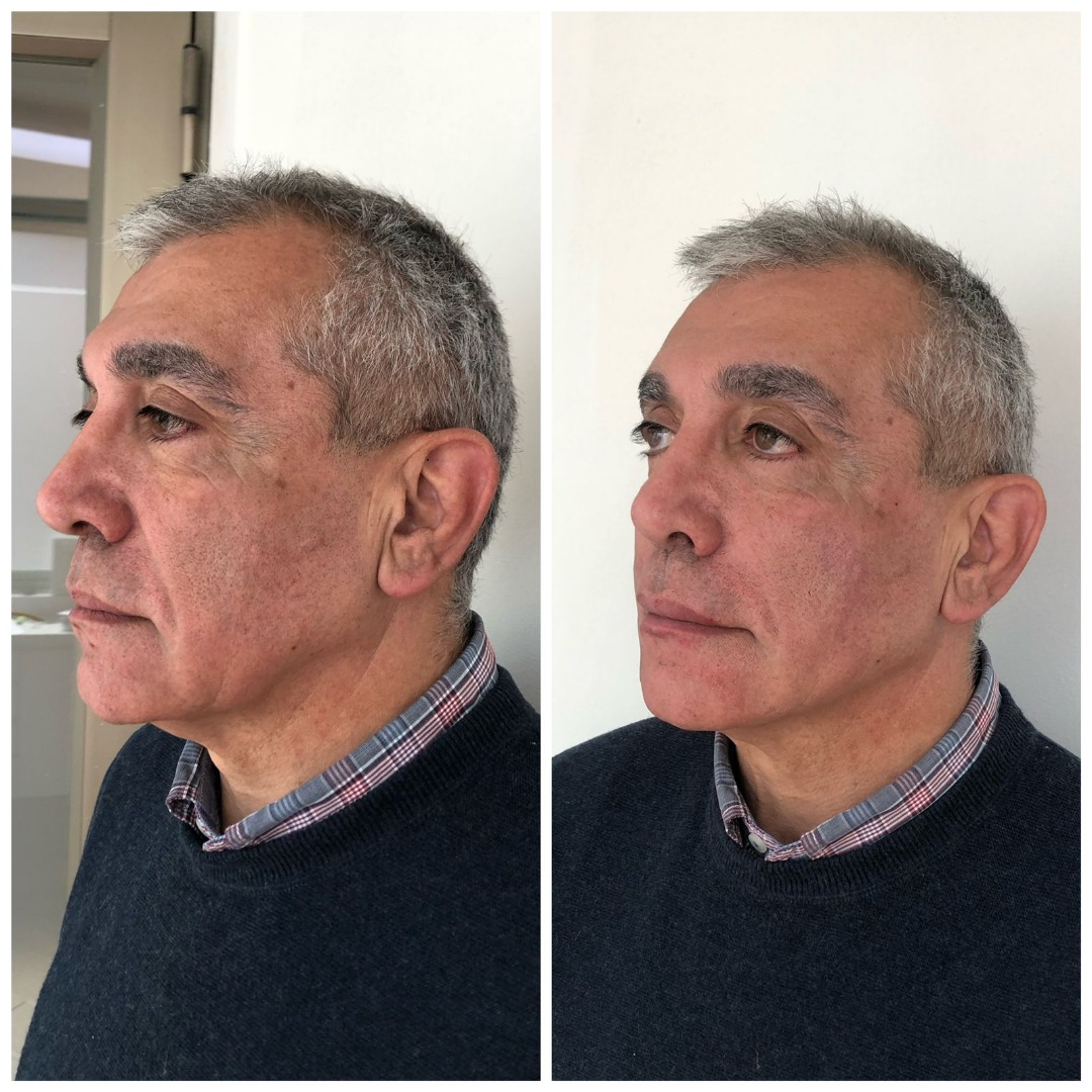 Rejuvenecimiento con hilos